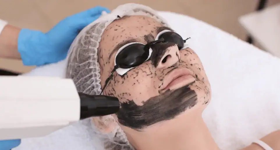 Caron peeling 1