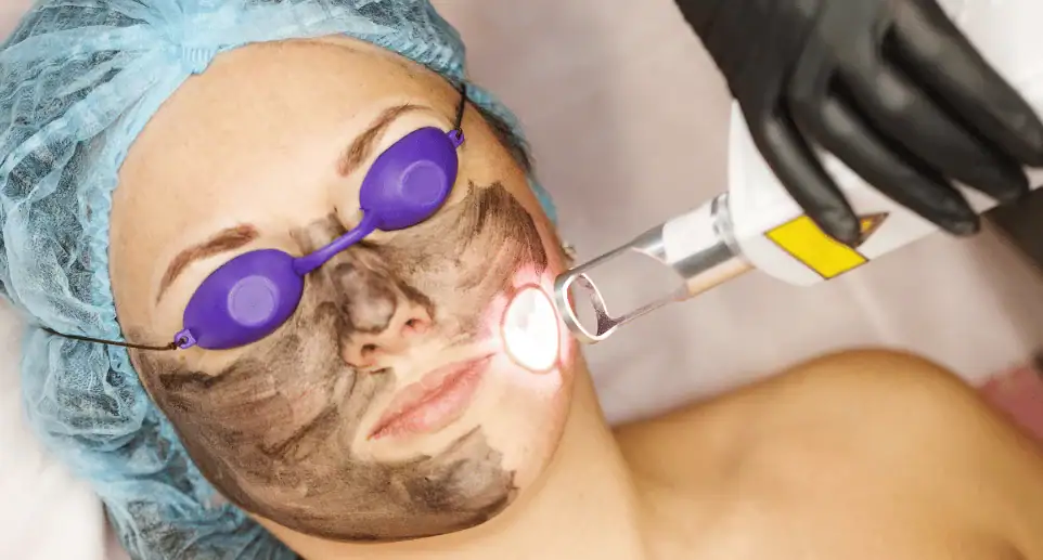Caron peeling 2