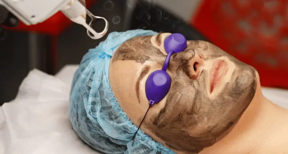 Caron peeling 3