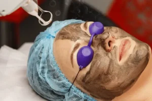 Caron peeling 3